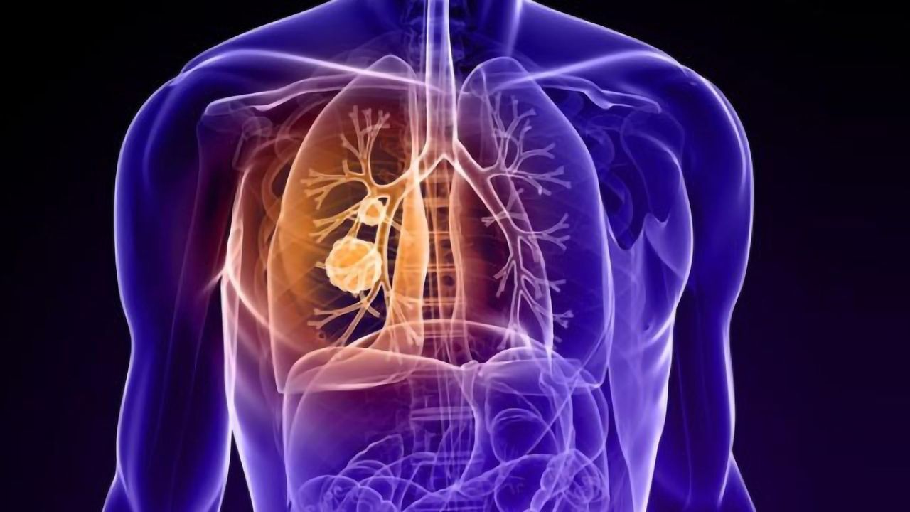 lung carcinoma treatment